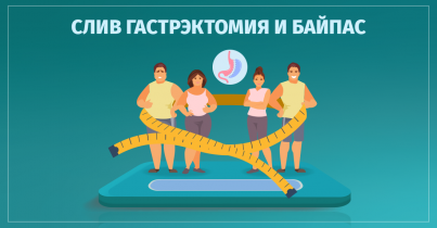 სლივგასტრექტომია და ბაიპასი 