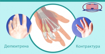 Как лечат контрактуру Дюпюитрена в Национальном центре хирургии?