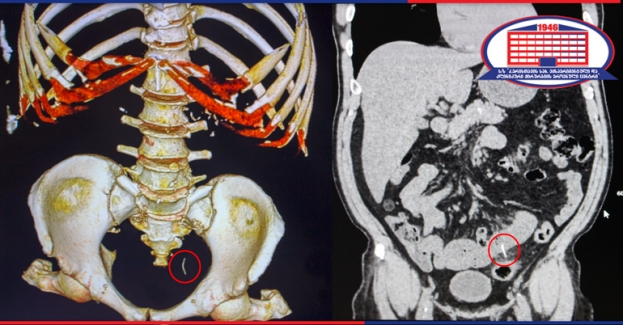 How did the wire get into the small intestine? - Doctors of the National Center of Surgery saved 59-year-old man from the peritonitis. 