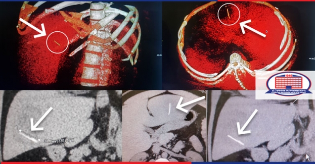 What is the patient's health condition after the surgery for removal of a fishbone from the liver?