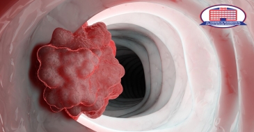 Health Condition of Patients with Duodenal Leiomyosarcoma Has Improved Using a Chemotherapy at The National Center of Surgery