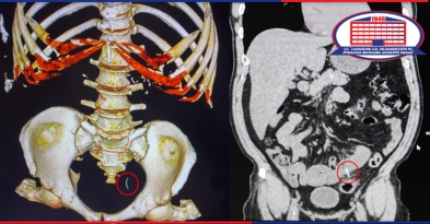 How did the wire get into the small intestine? - Doctors of the National Center of Surgery saved 59-year-old man from the peritonitis. 