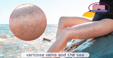 The sea can be a medicine for the varicose veins if you follow these 7 rules