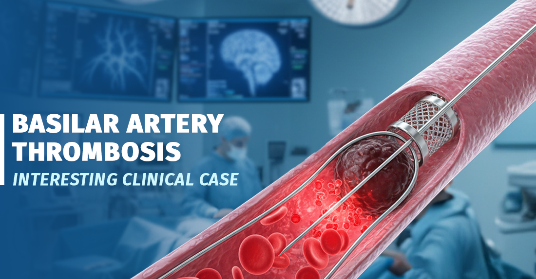 ბაზილარული არტერიის თრომბოზი ათეროსკლეროზული ფოლაქის ფონზე