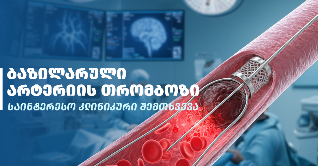 ბაზილარული არტერიის თრომბოზი ათეროსკლეროზული ფოლაქის ფონზე