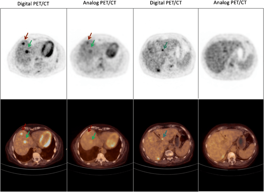 digital-pet-ct-analog-pet-ct